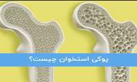 پوکی استخوان در اثر ضعیف شدن استخوانها ایجاد می شود