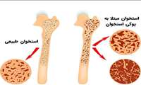 کدام بیماری به صورت چراغ خاموش قد شما را کوتاه می کند؟/کمپینی برای شما 
